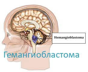 Узнать о лечении гемангиобластомы в Израиле