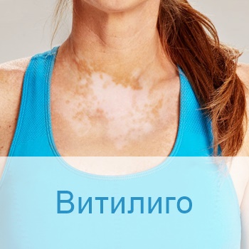 лечение витилиго в больницах Израиля
