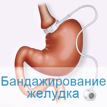 Бандажирование желудка в Израиле