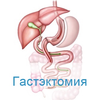 гастрэктомия в Израиле