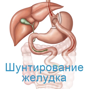 шунтирование желудка в Израиле