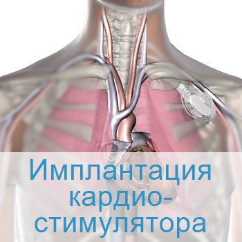Имплантация кардиостимулятора в Израиле