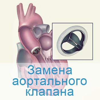 Стентирование в Израиле