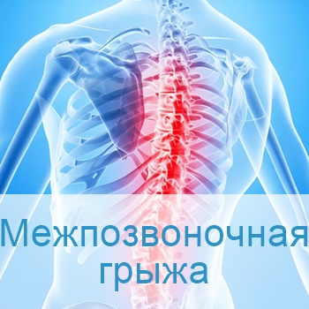 Лечение межпозвоночной грыжи в Израиле