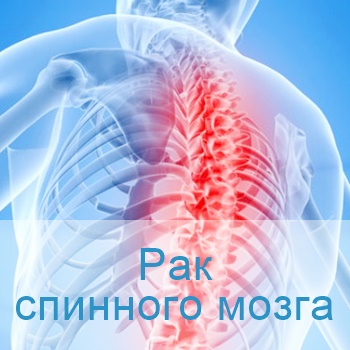 лечение рака спинного мозга в клиниках Израиля