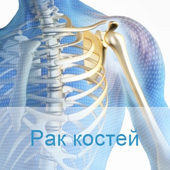 терапия онкологии костей в Израиле
