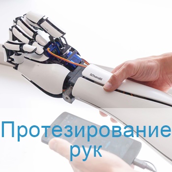 протезирование рук в Израиле