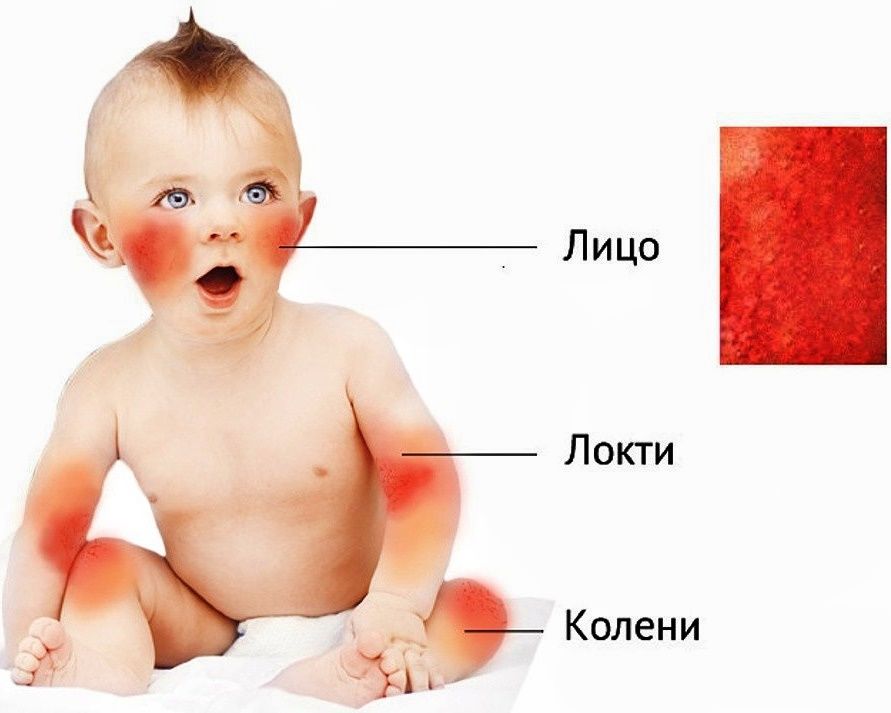 лечение атопического дерматита в Израиле