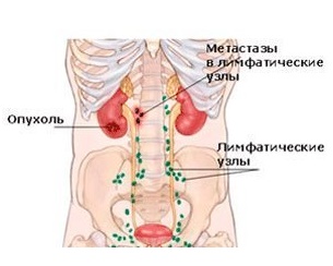 лечение рака с метастазами в израиле