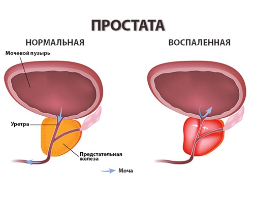 лечение простатита в клиниках Израиля
