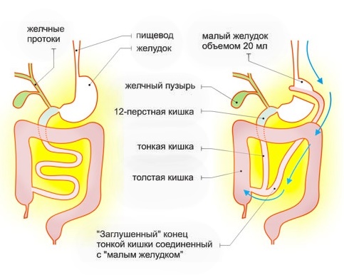 шунтирование желудка в больницах Израиля